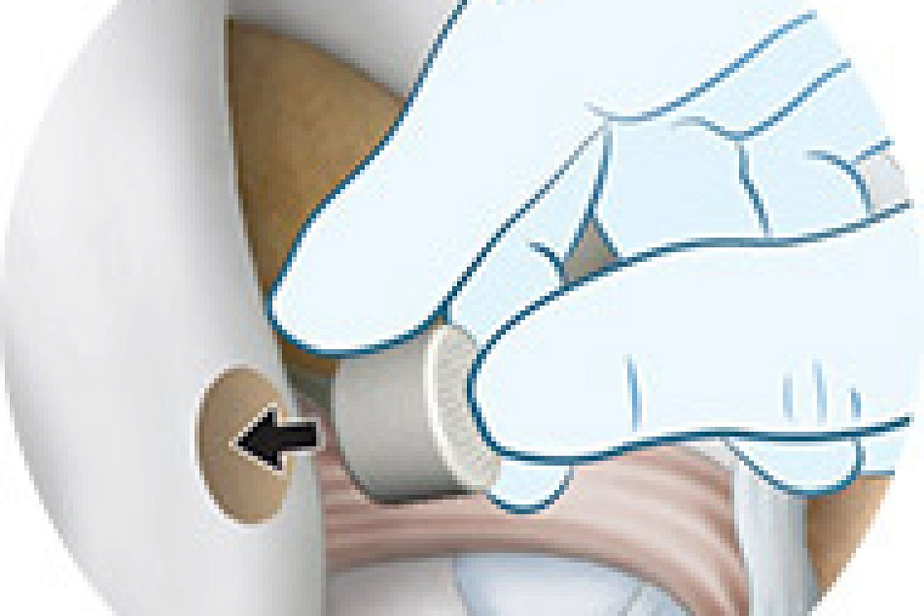 Inserting the Agili-C implant into damaged bone. Source:  Cartiheal.com