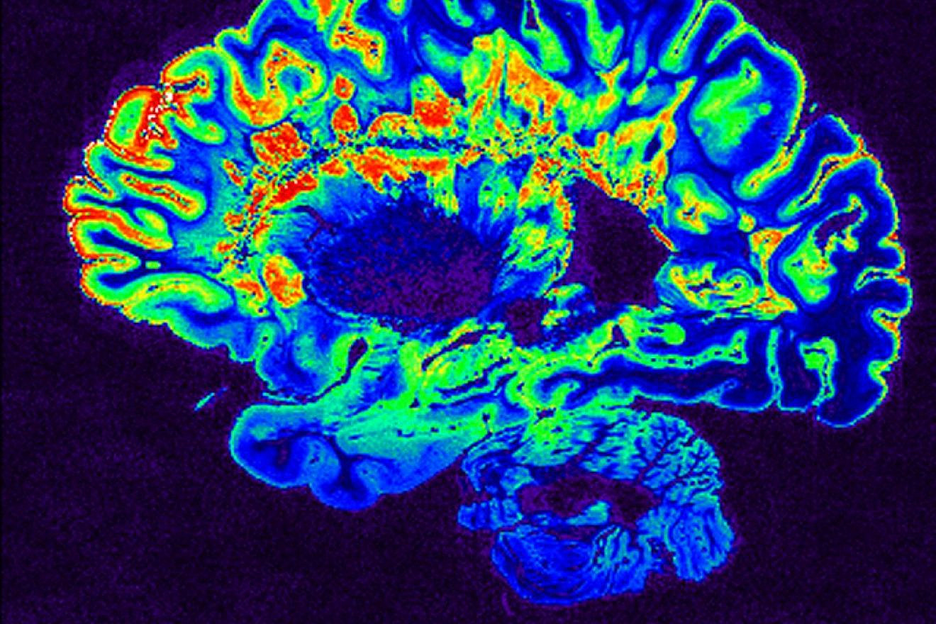 A MRI scan of a human brain. Credit: Flickr.