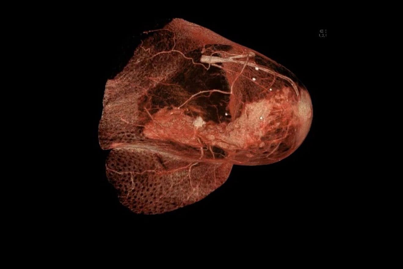 Image of a tumor in the breast, June 18, 2021 Credit: Rsmskns via Wikimedia Commons.