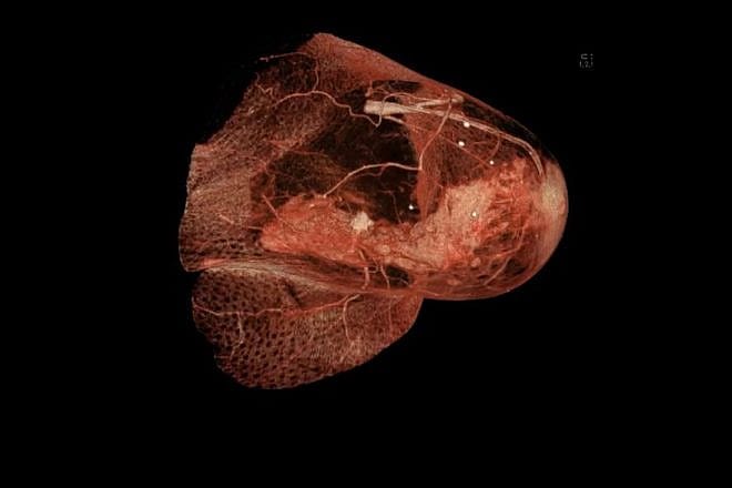 Image of a tumor in the breast, June 18, 2021 Credit: Rsmskns via Wikimedia Commons.