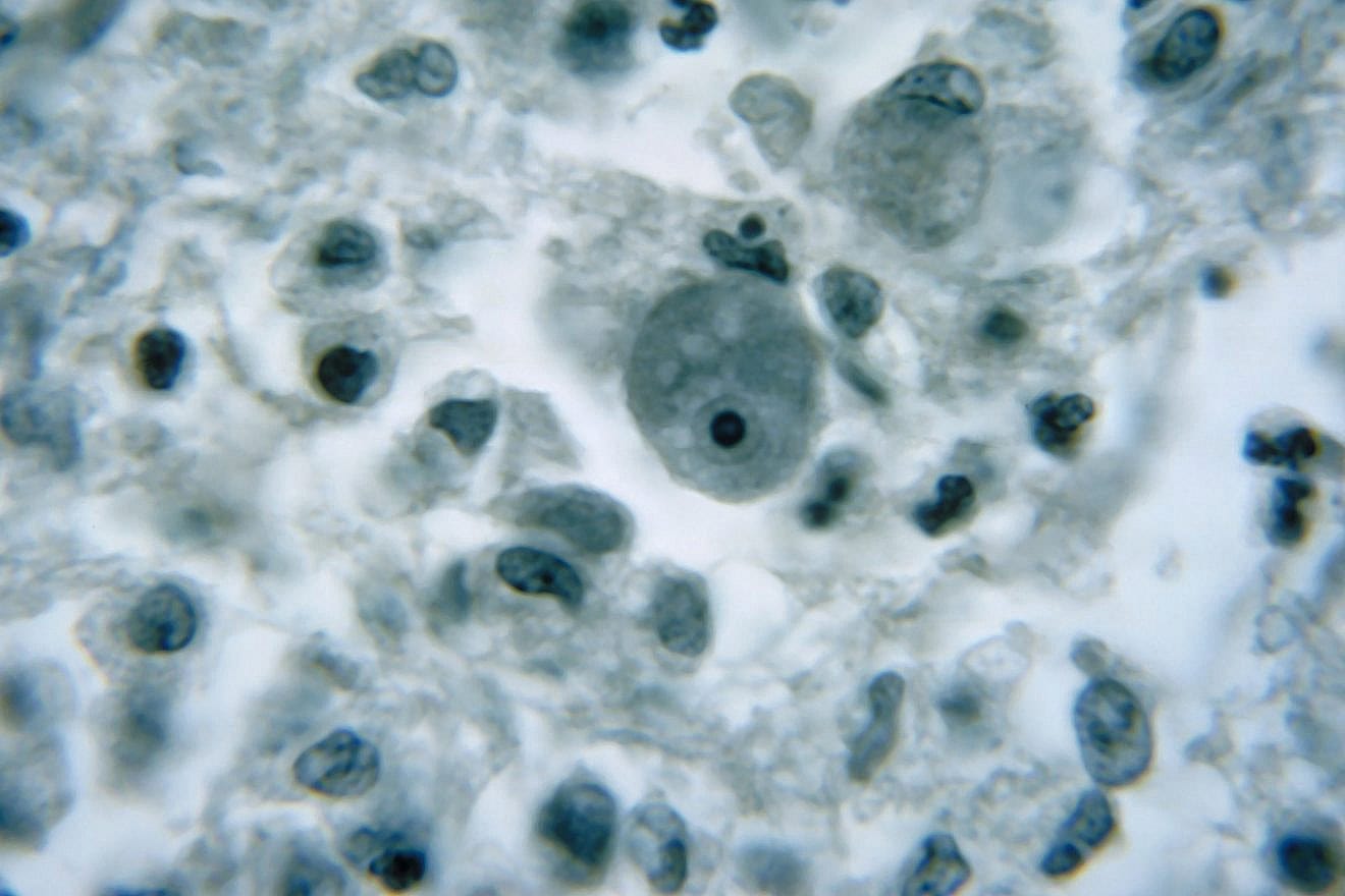 This photomicrograph of a brain tissue specimen depicts the cytoarchitectural changes associated with a free-living amebic infection, which may have been caused by either a Naegleria fowleri, or an Acanthamoeba sp. Naegleria fowleri produces an acute, and usually lethal, central nervous system (CNS) disease called primary amebic meingoencephalitis (PAM). Trophozoites infect humans or animals by entering the olfactory neuroepithelium and reaching the brain. N. fowleri trophozoites are found in cerebrospinal fluid (CSF) and tissue, while flagellated forms are occasionally found in CSF. Image courtesy CDC/Dr. Martin D. Hicklin, 1964. Photo by Smith Collection/Gado/Getty Images.