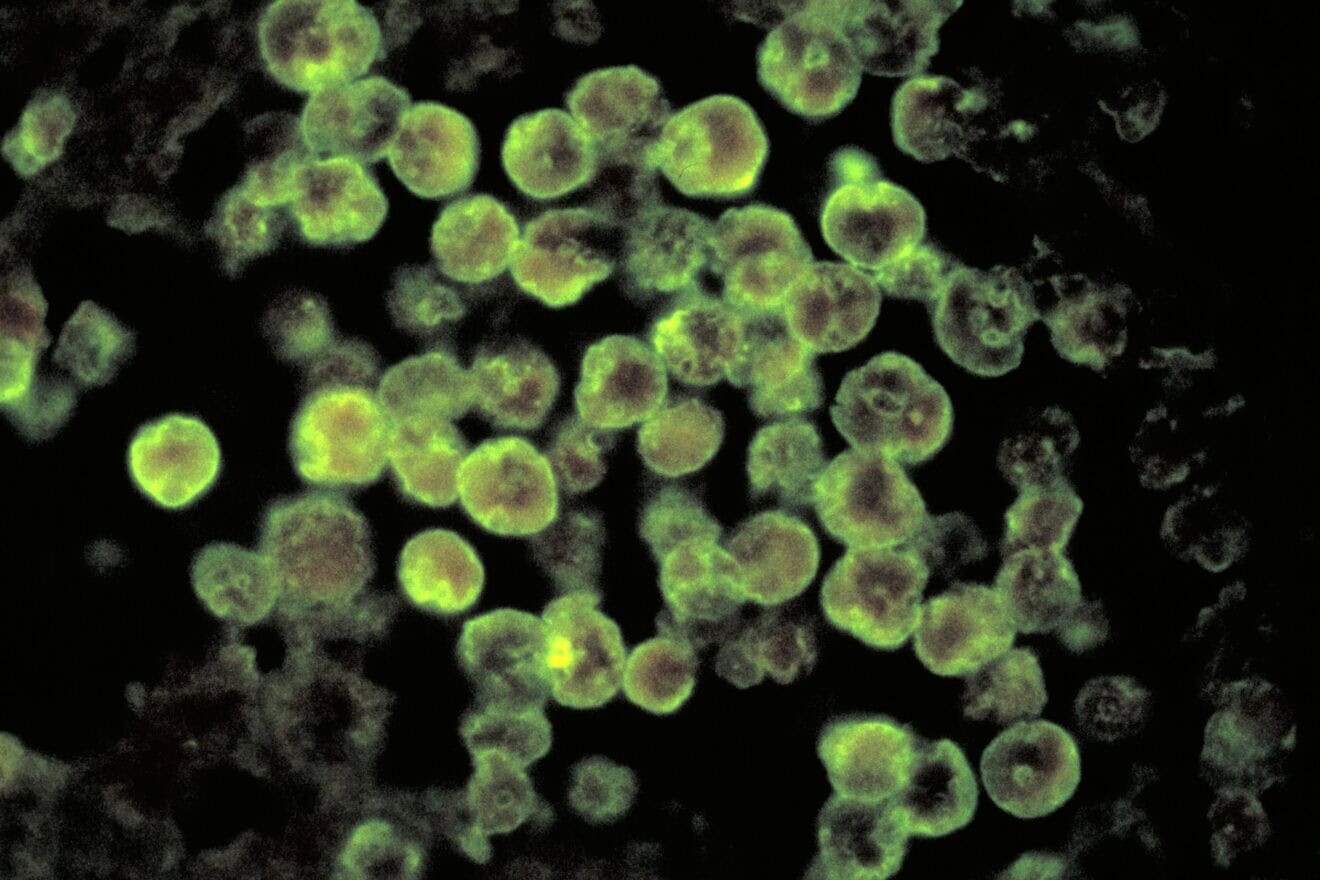 Using the direct fluorescent antibody (DFA) staining technique, this photomicrograph depicts histopathologic characteristics associated with a case of amebic meningoencephalitis due to Naegleria fowleri parasites. Naegleria fowleri infects people when water containing the ameba enters the body through the nose, typically when people go swimming or diving in warm freshwater places like lakes and rivers. The ameba then travels up the nose to the brain, where it destroys the brain tissue. Credit: Courtesy CDC/Dr. Govinda S. Visvesvara, 1980. Photo by Smith Collection/Gado/Getty Images.