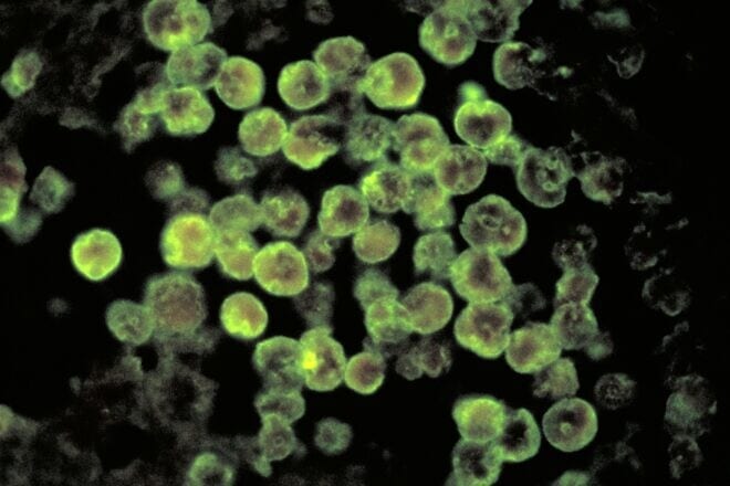 Using the direct fluorescent antibody (DFA) staining technique, this photomicrograph depicts histopathologic characteristics associated with a case of amebic meningoencephalitis due to Naegleria fowleri parasites. Naegleria fowleri infects people when water containing the ameba enters the body through the nose, typically when people go swimming or diving in warm freshwater places like lakes and rivers. The ameba then travels up the nose to the brain, where it destroys the brain tissue. Credit: Courtesy CDC/Dr. Govinda S. Visvesvara, 1980. Photo by Smith Collection/Gado/Getty Images.