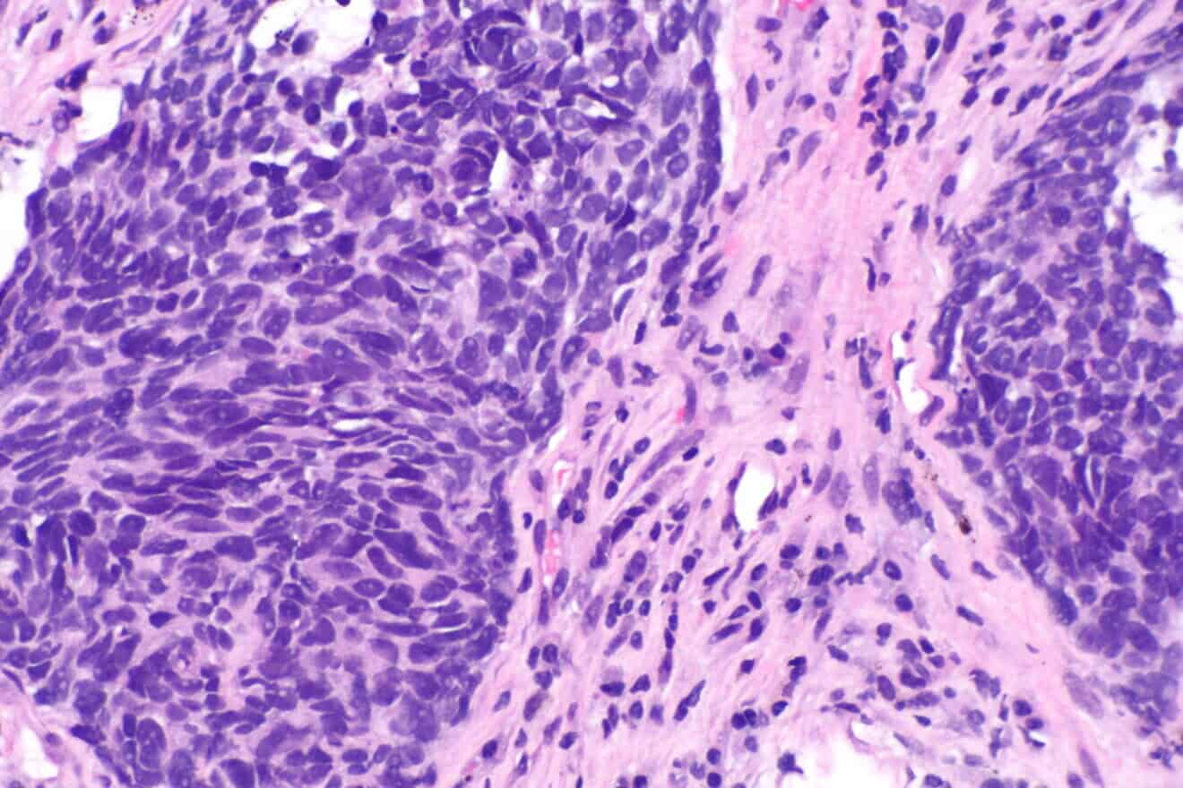 A high magnification of non-small cell lung carcinoma. Credit: Librepath via Wikimedia Commons.