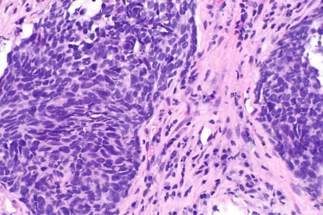 A high magnification of non-small cell lung carcinoma. Credit: Librepath via Wikimedia Commons.